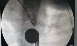 Siirt’te Boğazına Madeni Para Kaçan Çocuk, Doktorların Müdahalesi ile Kurtarıldı