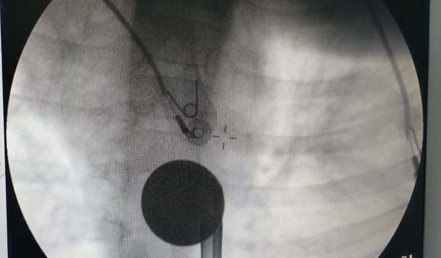 Siirt’te Boğazına Madeni Para Kaçan Çocuk, Doktorların Müdahalesi ile Kurtarıldı